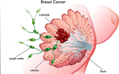 乳腺癌的早期症状有哪些 如何预防