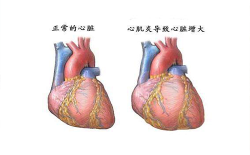 感冒后不要运动容易导致心肌炎