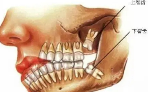 智齿是长出来拔还是没长出来拔