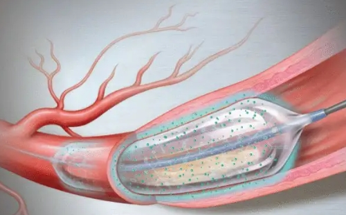 冠脉扩张球囊是什么_价格多少钱